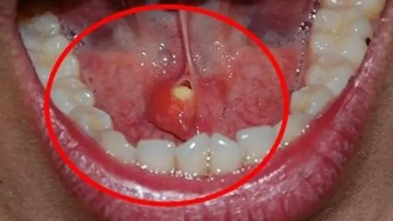 Ağızdaki sessiz tehlike: Tükürük bezi taşı  Ağızdaki sessiz tehlike: Tükürük bezi taşı
