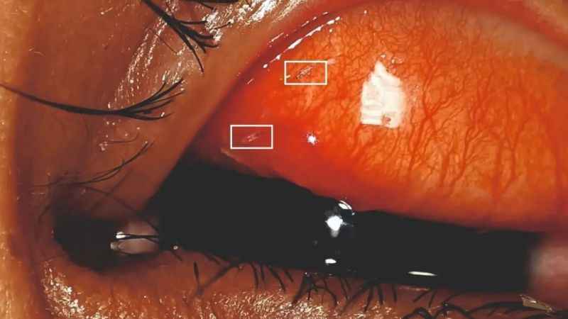 Gözünden sinek larvaları çıktı Gözünden sinek larvaları çıktı