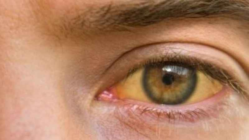 Yazın göz sağlığını korumanın püf noktaları Yazın göz sağlığını korumanın püf noktaları